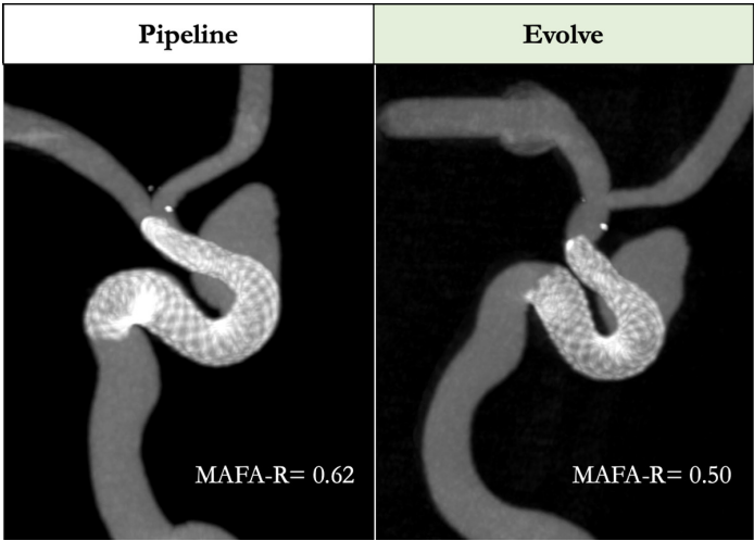 JNIS_BMJ's tweet photo. Cancelliere et al: Comparison of intra-aneurysmal flow modification using optical flow imaging to evaluate the performance of Evolve and Pipeline flow diverting stents. https://t.co/MwspOGwE1I https://t.co/3c9I58u4CL