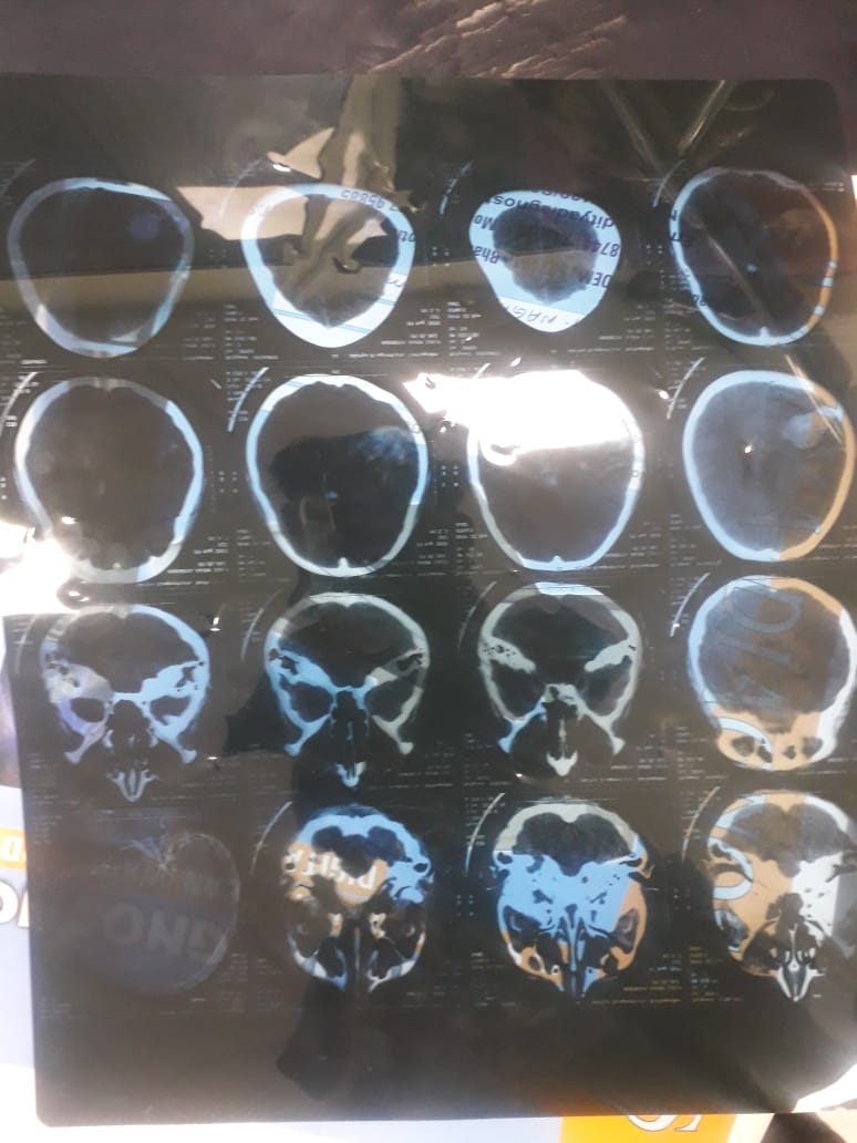 <a href="/offl_Lawrence/">Raghava Lawrence</a> <a href="/Suriya_offl/">Suriya Sivakumar</a> Respected  sir, Our sister Sk.Anjum Age 14 yrs .suffering with brain tumor,her condition is critical, we need some help from urs side sir. sir parents no:9908665071,OSMANIA GENERAL HOSPITAL.REG NO: 38298.Her proper address: Bhadradrikothagudem(dist) TS