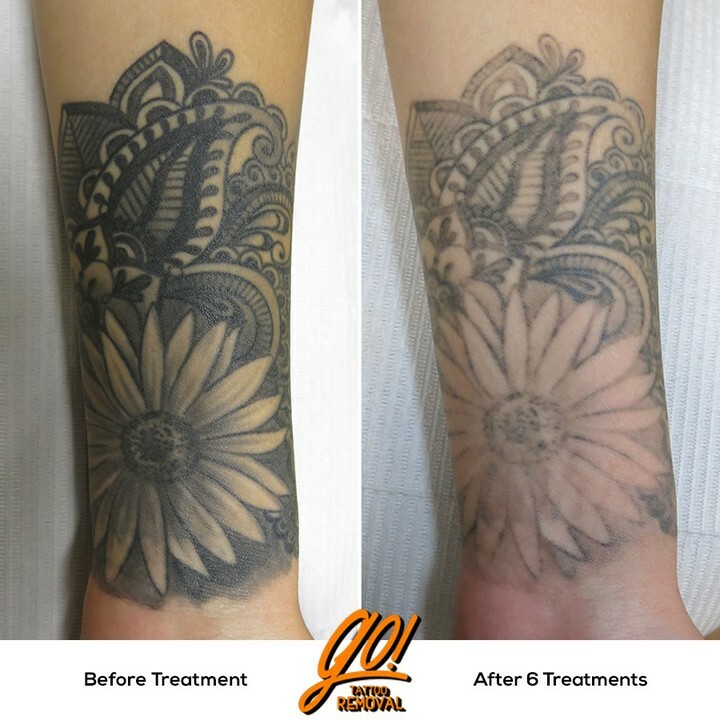 My Tattoo Removal Experience  PaleOMG