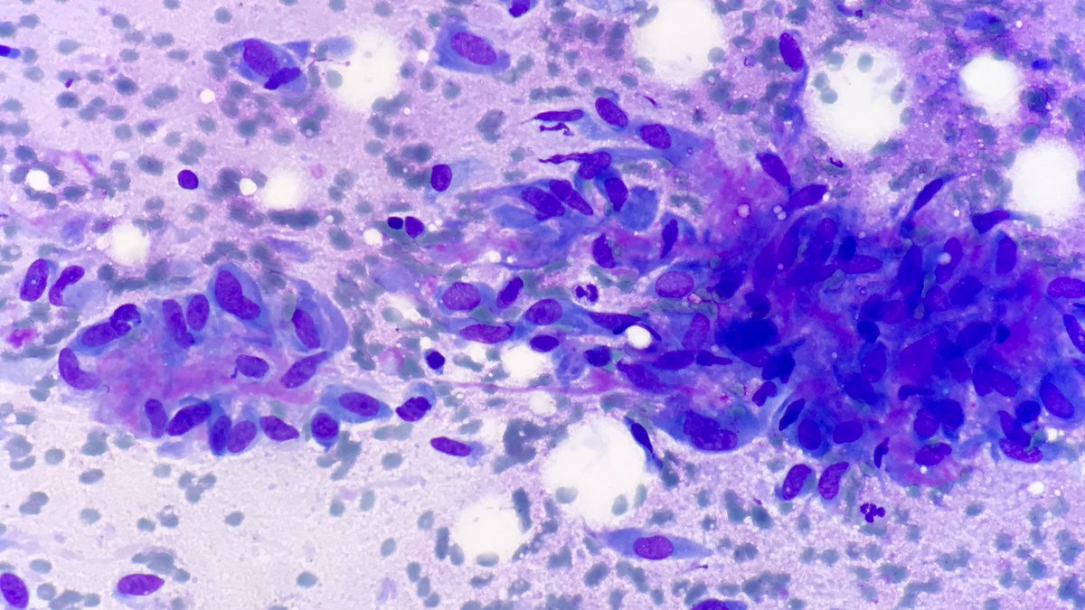 HubertLauMD's tweet photo. 35-year-old man, 2 cm abdominal wall mass.

Plump spindle cells with evenly distributed chromatin and occasional conspicuous nucleoli within a myxoid background. Smooth muscle actin #IHCpath positive.

USP6 FISH positive, confirming nodular fasciitis. #FNApath #Cytopath #STpath https://t.co/ksMSTHKILr