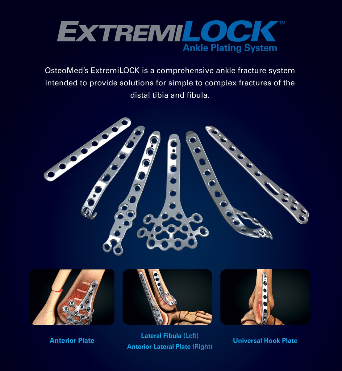 OsteoMedSOURCE's tweet image. The system is one of the first to feature double-lead screw technology in locking, non-locking and #cannulated screw options.

For more information please visit: bit.ly/2LhXK58