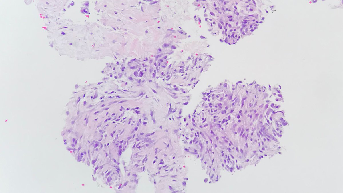 HubertLauMD's tweet photo. 35-year-old man, 2 cm abdominal wall mass.

Plump spindle cells with evenly distributed chromatin and occasional conspicuous nucleoli within a myxoid background. Smooth muscle actin #IHCpath positive.

USP6 FISH positive, confirming nodular fasciitis. #FNApath #Cytopath #STpath https://t.co/ksMSTHKILr