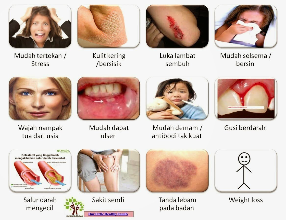 تويتر 𝐤𝐚𝐤𝐦𝐢𝐧 Scarves Bag على تويتر Tanda Badan Kurang Vit C 1 Gusi Mudah Berdarah Amp Bengkak 2 Hujung Rambut Kering Amp Bercabang 3 Hidung Berdarah 4