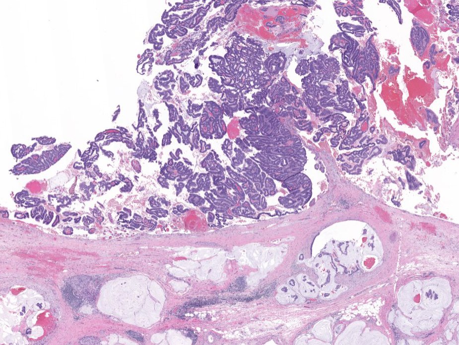 OlcaBasturk's tweet photo. Speaking of pancreatic #intraductalneoplasms, this is a typical example of intestinal type intraductal papillary mucinous neoplasm (#IPMN) with an associated #colloidcarcinoma. Most main duct IPMNs are of intestinal type. Intraductal component resembles colonic villous adenomas. https://t.co/kklC1I4Rdp