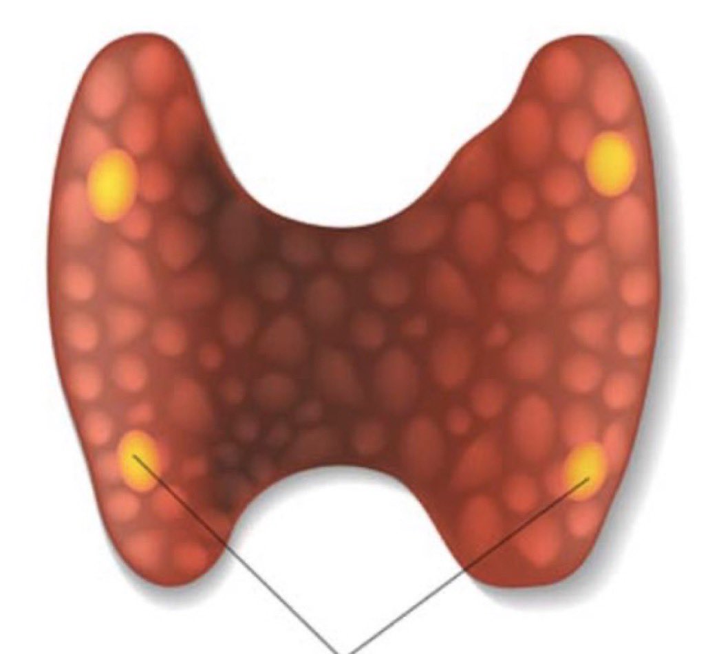 RASACS's tweet photo. Join us tonight at 7 CST for #QuarantineSurgEd Parathyroid case discussions lead by endocrine surgery fellow @JoanaOchoaMD and @JamesWuSurgery from #UCLAEndocrine - discussion promised to have as much Calcium as a glass of milk! 🥛
Sign up to join us at https://t.co/0doscNkOyS https://t.co/Z3qpc5jVUV