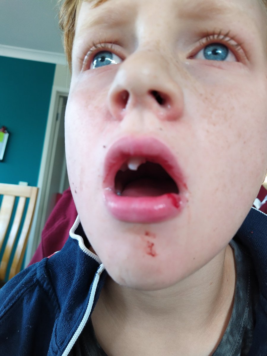coxyman's tweet photo. Ok need some help guys! My 9 yr old Nathaniel just crashed his bike this morning+lost his 2 front teeth. Need some words of encouragement! Worried he might not want to get back on!! 😟🙏 @richie_porte @HansenAdam @AnnaMeares @CyclingCentral @jesspratt97 @CadelOfficial @cam https://t.co/2C1l6ryENv