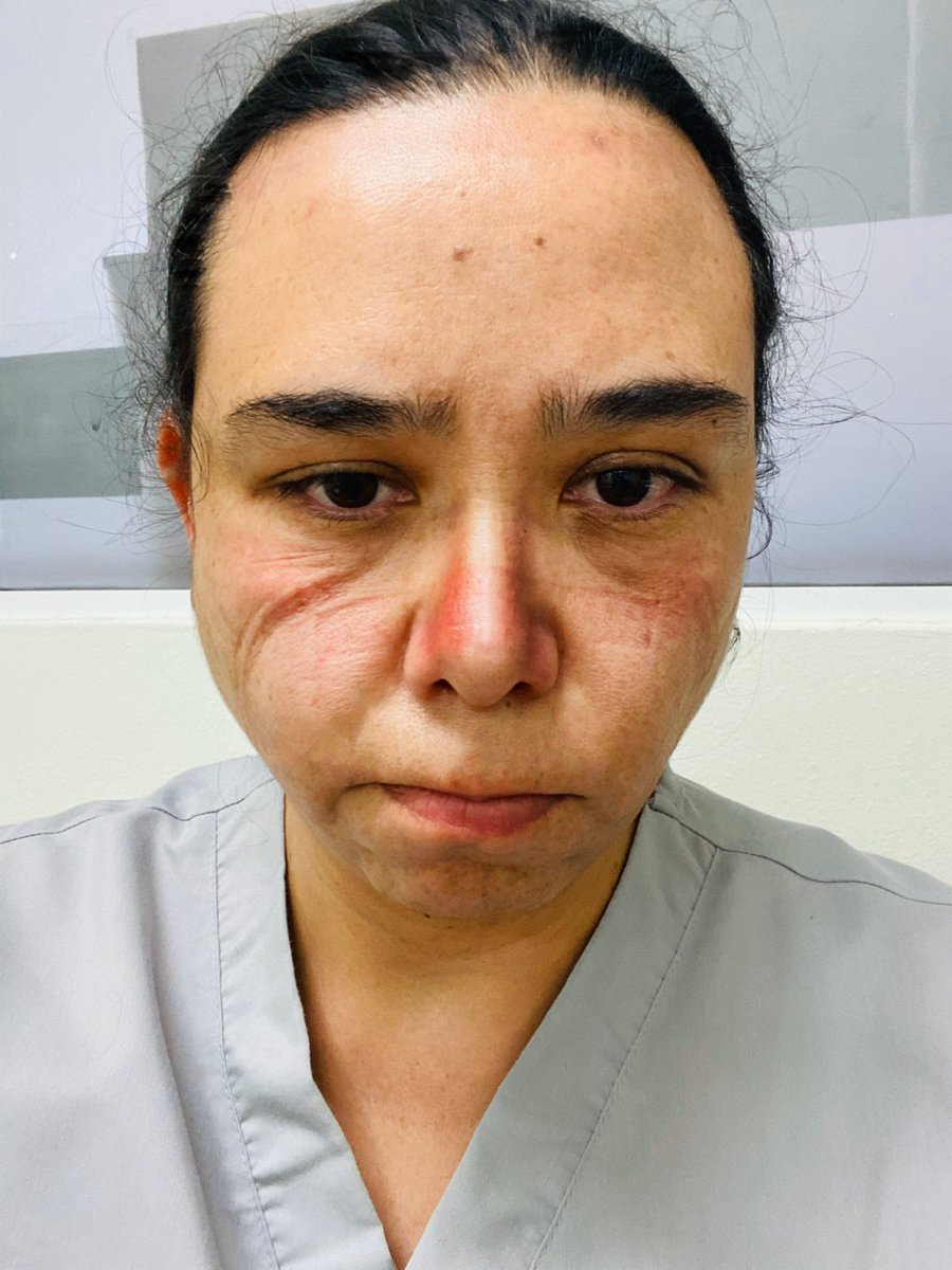 Así luzco sin filtros después de un turno de 8h, agotada, deshidratada, pero con la satisfacción de haber ayudado a ganar una batalla más en contra del enemigo invisible.