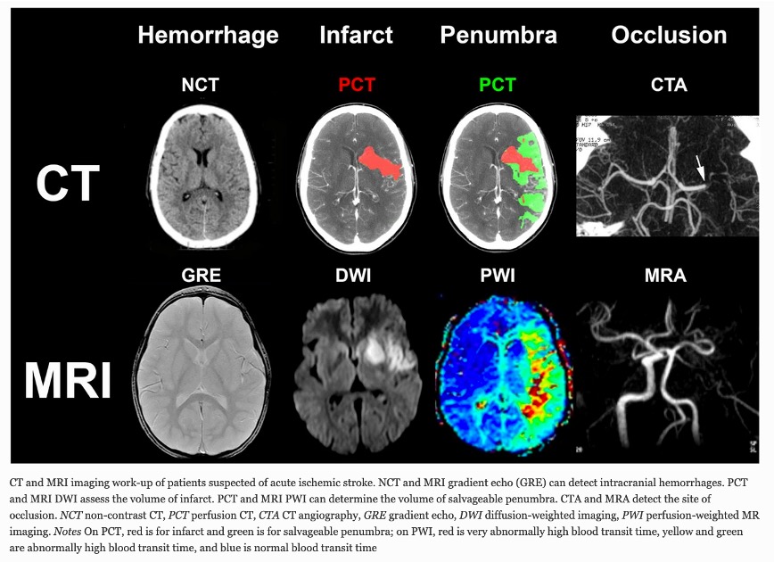 yourICM's tweet photo. What’s new in imaging of acute stroke? Free read at: https://t.co/WBwDDSjO6A

@yourICM
@Dr_Cit
@ClinMedJournals
@ESICM https://t.co/ZsRAsQjiUN