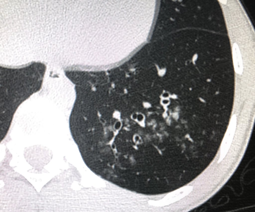 DrChinkyChatur's tweet image. 19 year old with fever.
Another very basic case with classic imaging findings. #DailyReporting #BasicRadiology #RadRes #ChestRad