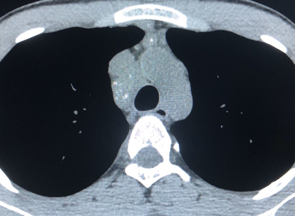 DrChinkyChatur's tweet image. 19 year old with fever.
Another very basic case with classic imaging findings. #DailyReporting #BasicRadiology #RadRes #ChestRad