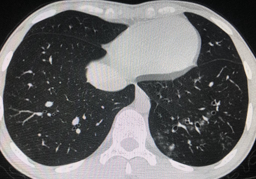 DrChinkyChatur's tweet image. 19 year old with fever.
Another very basic case with classic imaging findings. #DailyReporting #BasicRadiology #RadRes #ChestRad