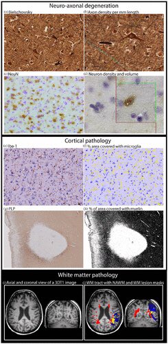 Cortical axonal loss is associated with both gray matter demyelination and white matter tract pathology in progressive #multiplesclerosis: Evidence from a combined MRI-histopathology study journals.sagepub.com/doi/full/10.11…