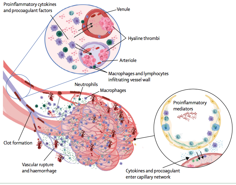 Los mecanismos inmunológicos detrás de la inflamación intersticial alveolar de la  #COVID19 implican una situación similar al "síndrome de activación macrofágica" que genera una inmunotrombosis que enmascararía una enfermedad cardiovascular subclínica.  https://www.thelancet.com/action/showPdf?pii=S2665-9913%2820%2930121-1