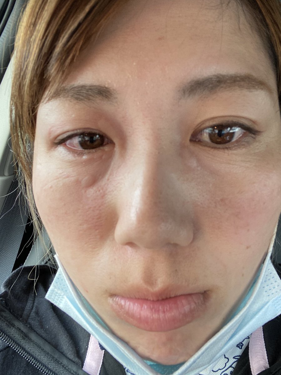 綾田 紘子 Auf Twitter ちょっと顔汚いしぐろいけど 目のとこに蕁麻疹みたいなの出ました 目の中も腫れてて これなにかわかるひといませんか 綾田 紘子 Auf Twitter ちょっと顔汚いしぐろいけど 目のとこに蕁麻疹みたいなの出ました 目の中も腫れてて これなにかわかるひといませんか