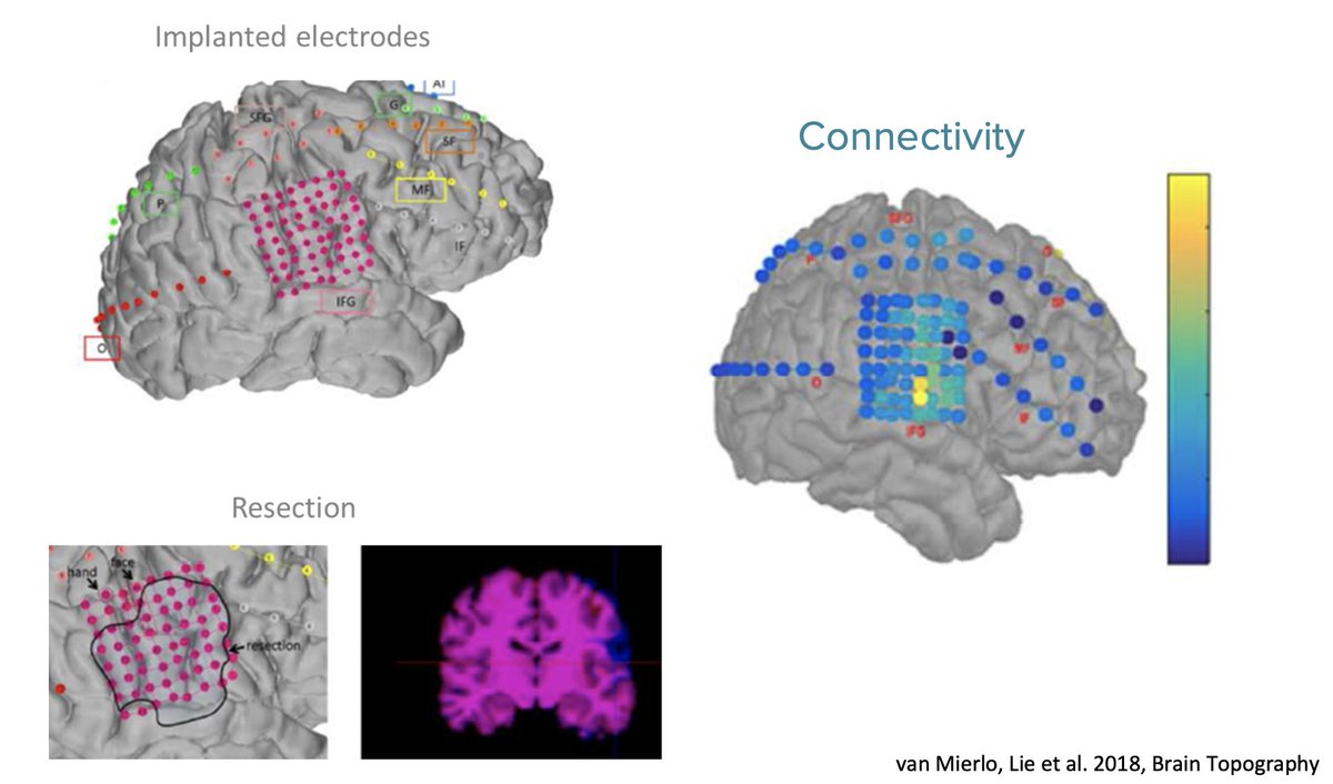 GregorStrobbe's tweet photo. Still possible to register for the Epilog Brain Research Webinar by Prof. Pieter van Mierlo. If you wanna join please reach out to natasja@epilog.care (Wednesday - May 13th 5pm CEST). Looking forward already: https://t.co/K29GBbPXra #eeg #epilepsy #uniquewindow #brainfunctioning https://t.co/tZwwBBBrRC