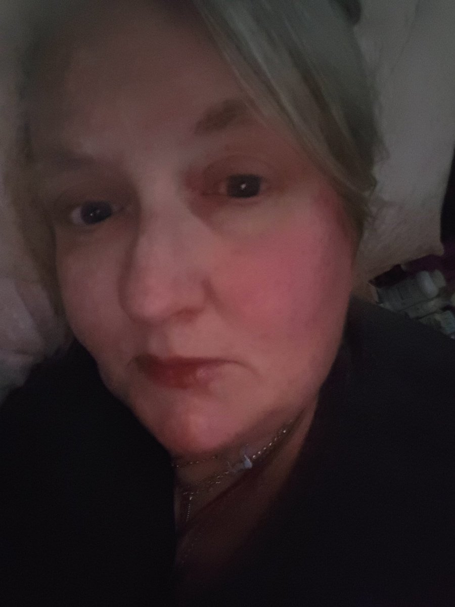 CarolDa42444571's tweet photo. Yet another bad day Severe ME has stolen my life its now an existence, an its #MEAwarenessDay #27yearsmissing #InvestinMe #WeneedchangeNOW #Biomedicalresearch #Iwantmylifeback
@Invest_in_ME @mermhart @LetsDoIt4ME @NHSuk https://t.co/09aCwLlGon