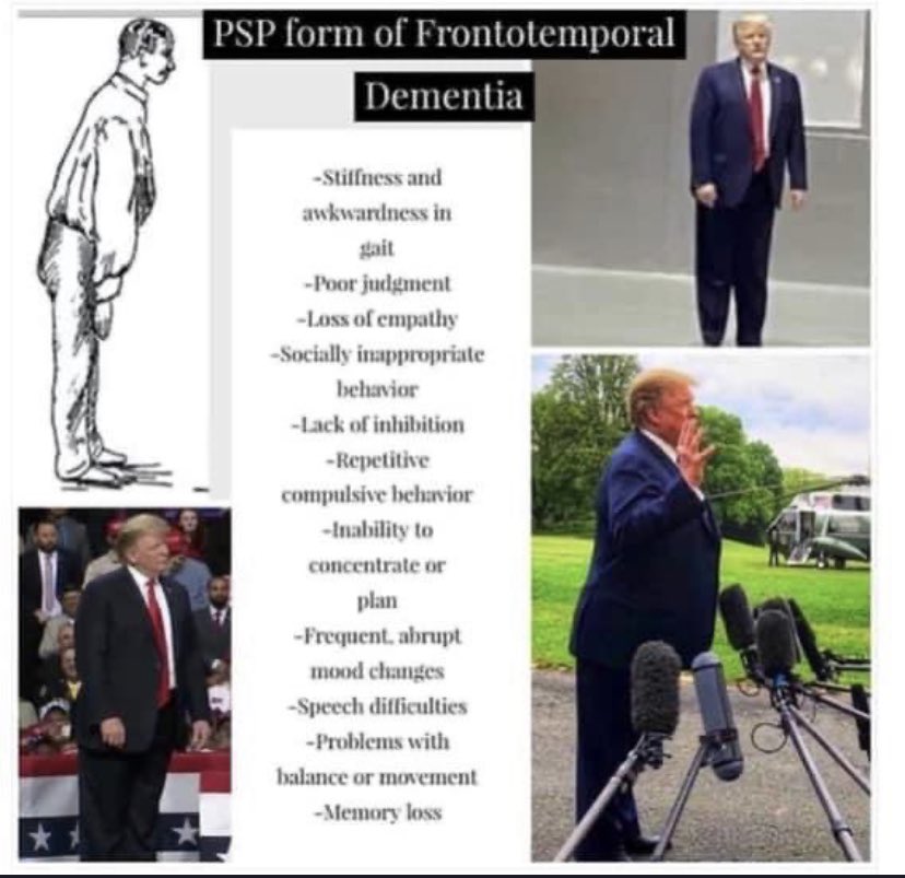 Frontotemporal dementia:  Poor judgment ~  Loss of empathy ~  Socially inappropriate behavior ~  Lack of inhibition ~  Repetitive compulsive behavior ~  Inability to