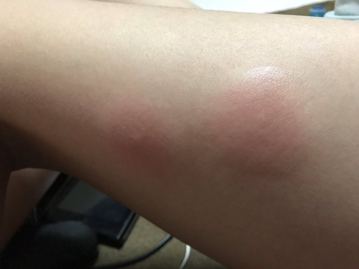 おはようございます(^^)

水曜日！！
くれぐれも蚊には気を付けて下さい！！
蚊に負けず今日も一日頑張ります！！
いや、今日も笑います（笑）

では、素敵な一日を！！

【次男の蚊に刺され】