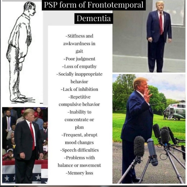 sheriffali's tweet image. #TrumpNeedsHelp From Possible – PSP - “Form of Frontotemporal Dementia!”
Republicans, Democrats and Independents, be Americans First ahead of Politics and consider with Donald Trump Being President, “America is at a very High-Risk.”