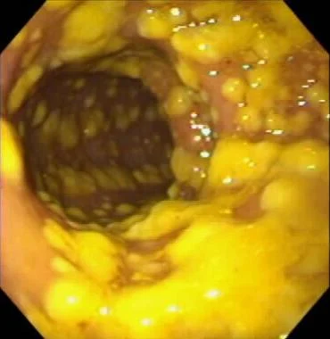 1/ While on my current GI rotation, I've been reading about Clostridioides difficile because, you know,  #IDNerd. I ran across something I had not learned about before:A Hypervirulent Strain of CDiff!So naturally, I had to look into this./thread  #Tweetorial  #CDiff  #IDTwitter