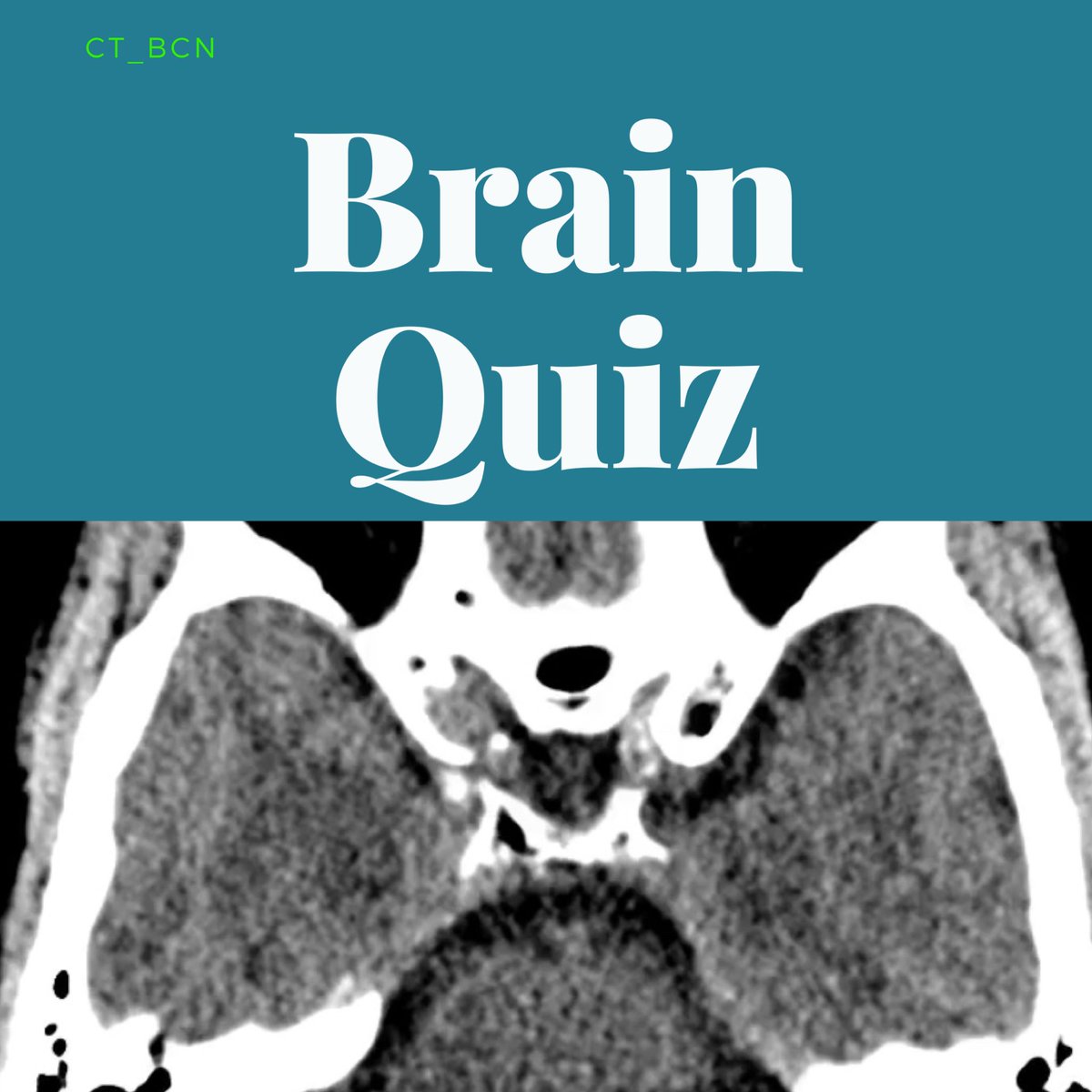 danyfcarame's tweet photo. Nuevo Caso de Imagen
https://t.co/OKZrV5xQwo
#rad #ctrad #xray #radiology #radiographer #foamed #foamrad #xraystudent #InstaRadiology #clinical #education @SERAM_RX @residentesSERAM @RadResidentARRS #Rad2B #RadBasics @seneurologia @AANMember @sociedadSENEC @AANSNeuro @OftalmoUniv https://t.co/qo40lldjYe