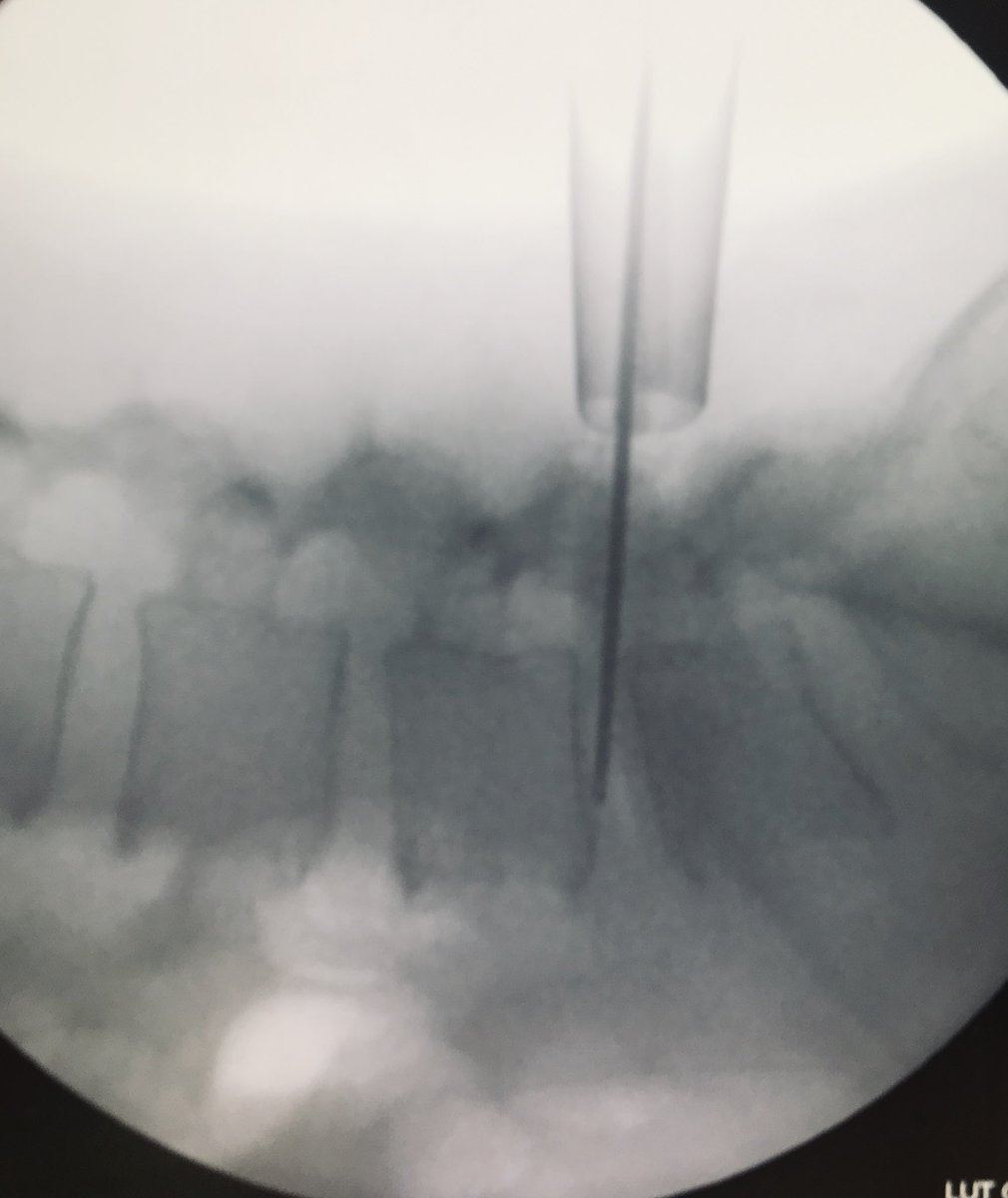 Unneurocx's tweet photo. #Hernia #discal #lumbar
#Microdiscectomía mínimamente invasiva #MISS
#Neurocirugía https://t.co/jeIycRUJDx