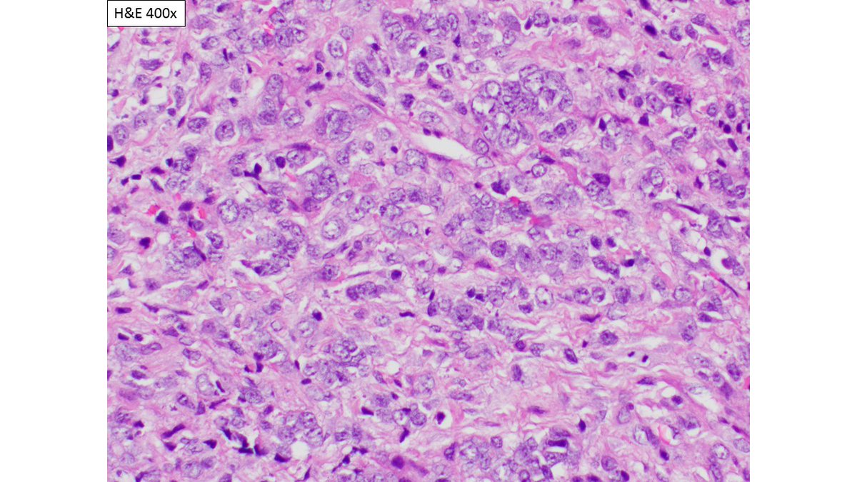 Infant, base of skull mass  #PediPath  #Pathology  #PathResidents  #smallbiopsyWhat is your dx, work-up plan,  #IHCPath? @mreyesm  @emckaymd  @MArnold_PedPath  @vhnguyenmd  @sranna86  @PathologySayah  @luishcruzc