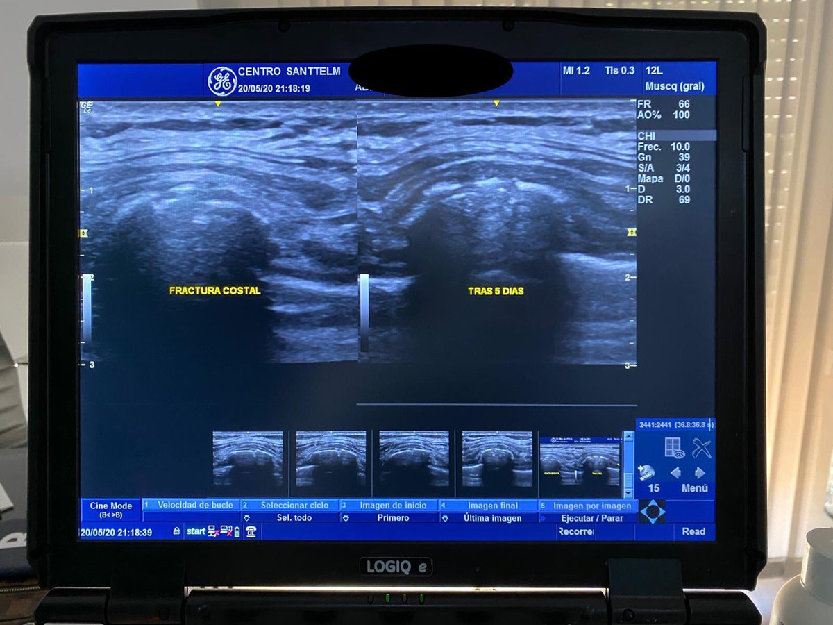 machofisio's tweet photo. Importancia de la Ecografia en fisioterapia para el Dx diferencial, confirmación y control evolutivo de los pacientes. Nuevos protocolos de tratamiento gracias a la novedosa #emfield zimmer de @primfisio que colabora en la aceleración de la remodelación ósea en fracturas. https://t.co/GBGAOZiCgl