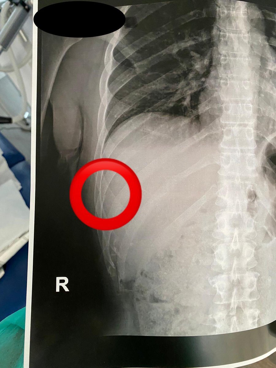 machofisio's tweet photo. Importancia de la Ecografia en fisioterapia para el Dx diferencial, confirmación y control evolutivo de los pacientes. Nuevos protocolos de tratamiento gracias a la novedosa #emfield zimmer de @primfisio que colabora en la aceleración de la remodelación ósea en fracturas. https://t.co/GBGAOZiCgl
