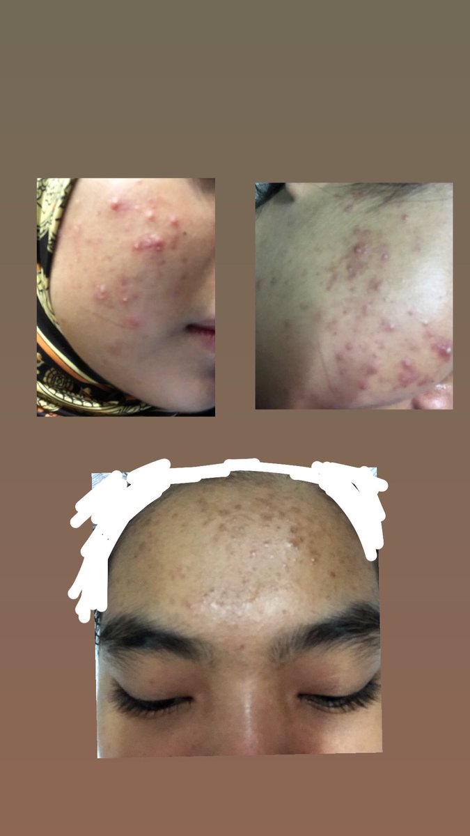 My skin journey since Jan > May, semua skincare routine yang i pakai, mostly i research from  @MaisarahMahmud thread. Thankyou for your tips and guideline. Even still ada parut but bersyukur sebab muka dah tak breakout  Thankyou so much awak! 