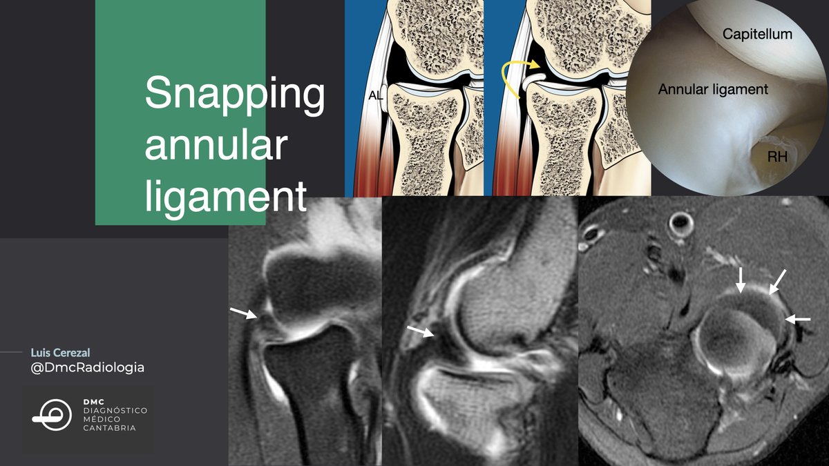 DmcRadiologia's tweet photo. Snapping annular ligament is an uncommon cause of lateral elbow pain. A torn or loose annular ligament could be displaced in the radiocapitellar joint, causing painful snapping of the lateral elbow joint.
MR arthrography and arthroscopic correlation https://t.co/Wgo561AJyX
