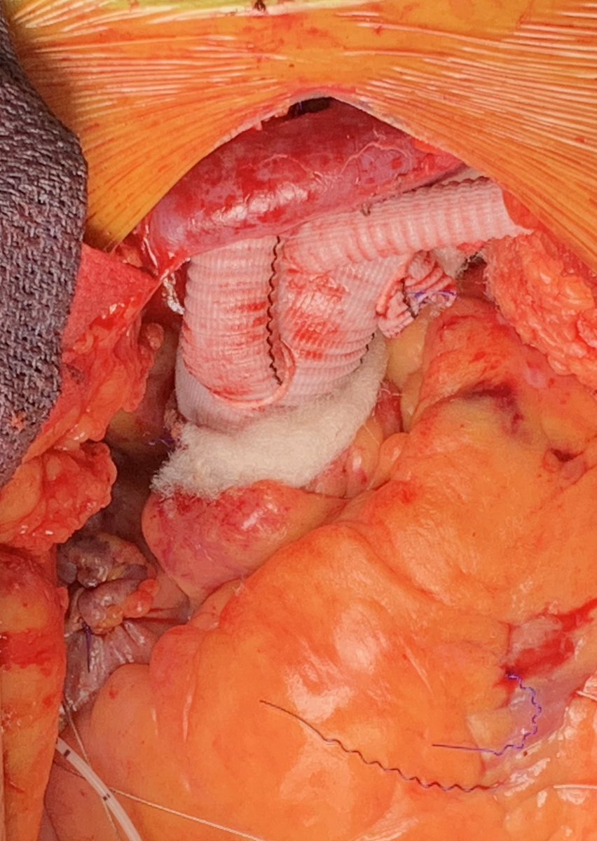 AnestHVH's tweet photo. We restart our Aortic Arch Surgery program after Covid 19 outbreak! @vallhebron @CardiacVall @LecoqRafael @anest_vhebron https://t.co/Tz1zqfa5Cv