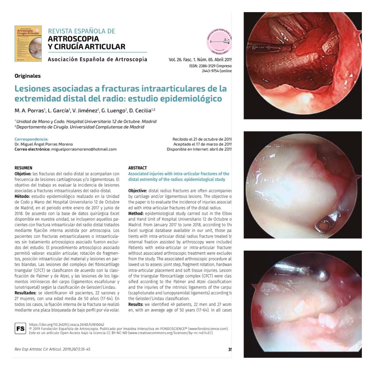aeartroscopia's tweet photo. 🟣ARTÍCULO REACA🟣 

✅Lesiones asociadas a fracturas intraarticulares de la
extremidad distal del radio: estudio epidemiológico✅

▪️71% presentaba lesión de partes blandas.
▪️34% lesión aislada del CFCT

🔸La artroscopia de muñeca permite valorar y tratar las lesiones asociadas https://t.co/VjvYDjSQye
