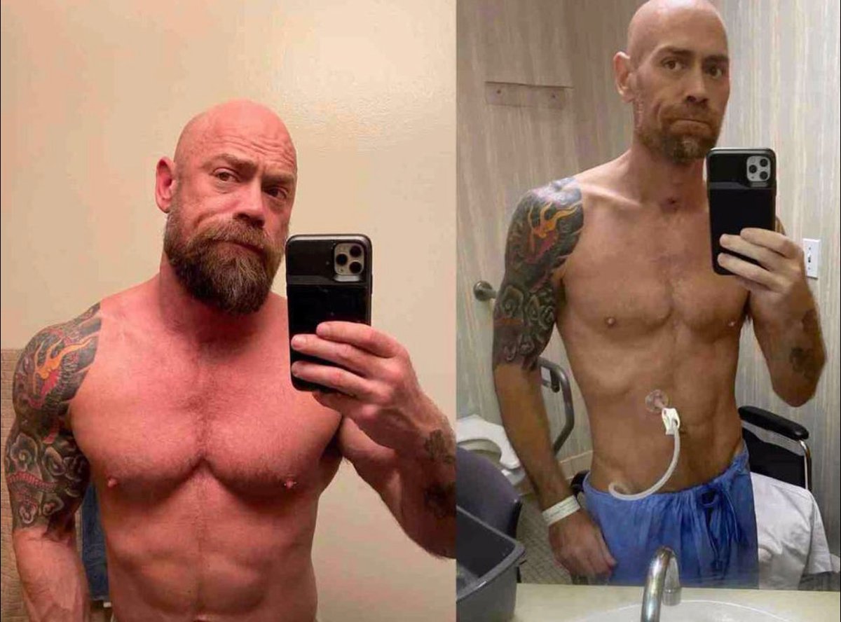 Pfleger aus LA verlor 25 kg durch Covid-19 und leidet noch immer an starker Atemnot. Durchtrainierter Sportler, keine Risikofaktoren, 6/Woche Gym. Er postet seine Geschichte wie viele andere in den USA als klare Warnung. Ob er sich völlig erholt ist unklar insider.com/nurse-shows-th…