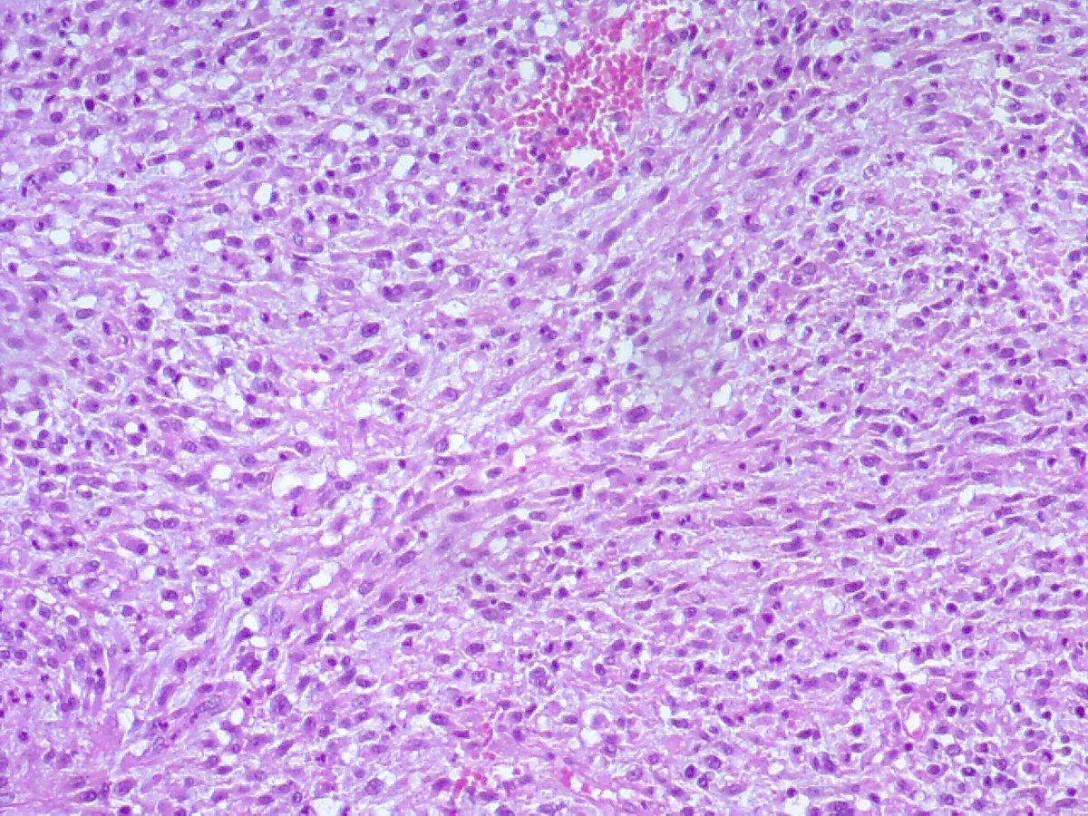#GUPath Urinary bladder mass, the procedurist describes as not usual pap carcinoma, unusually gelatinous, patient with osteoblastic bone mets. Please your thoughts, your diagnoses or DDs, and immuno requests if any .2 sets of pics , more of the spindly component on second set😊🙏
