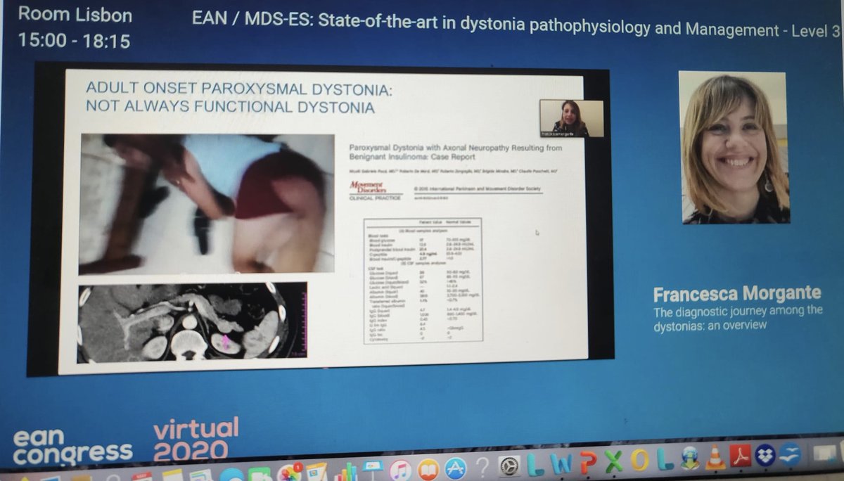 Francesca Morgante (@franci_morgante) on Twitter photo That moment when the virtual congress becomes #live for you! Thanks <a href="/EANeurology/">European Academy of Neurology</a> and <a href="/movedisorder/">MDS</a> for the amazing support and for this session on #Dystonia. Educating on Dystonia diagnosis, mechanism and treatment is the key to provide a better care @dystoniaeurope <a href="/ARDistonia/">Associazione Italiana Ricerca Distonia - A.R.D.</a> That moment when the virtual congress becomes #live for you! Thanks <a href="/EANeurology/">European Academy of Neurology</a> and <a href="/movedisorder/">MDS</a> for the amazing support and for this session on #Dystonia. Educating on Dystonia diagnosis, mechanism and treatment is the key to provide a better care @dystoniaeurope <a href="/ARDistonia/">Associazione Italiana Ricerca Distonia - A.R.D.</a>