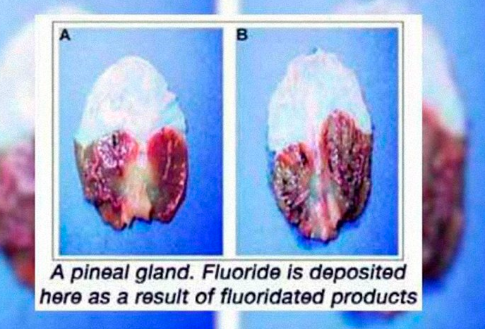 3What is brain sand, Brain Sand is when calcium builds up in the pineal gland of the brain and essentially calcifies the gland preventing it from working. This is what a calcified pineal gland looks like;