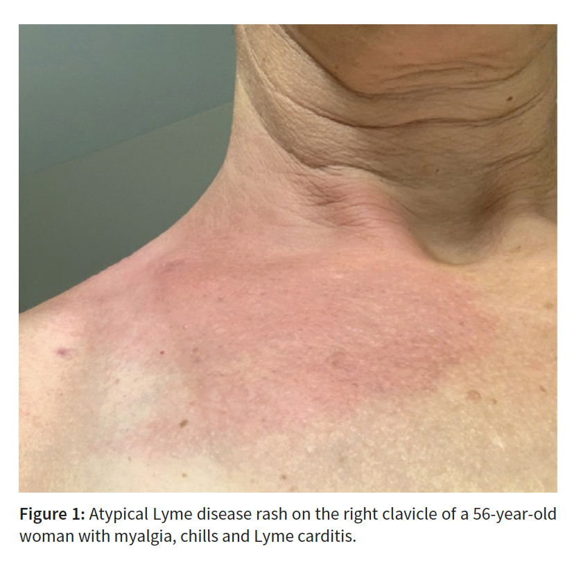 Recognition of skin presentations of #Lyme carditis, like this cellulitis-like rash, and treatment with antibiotics can prevent unnecessary pacemaker implantation in otherwise healthy patients: cmaj.ca/lookup/doi/10.… @dennys_franc @yeung_cynthia @adribaran #FOAMed #Cardiology