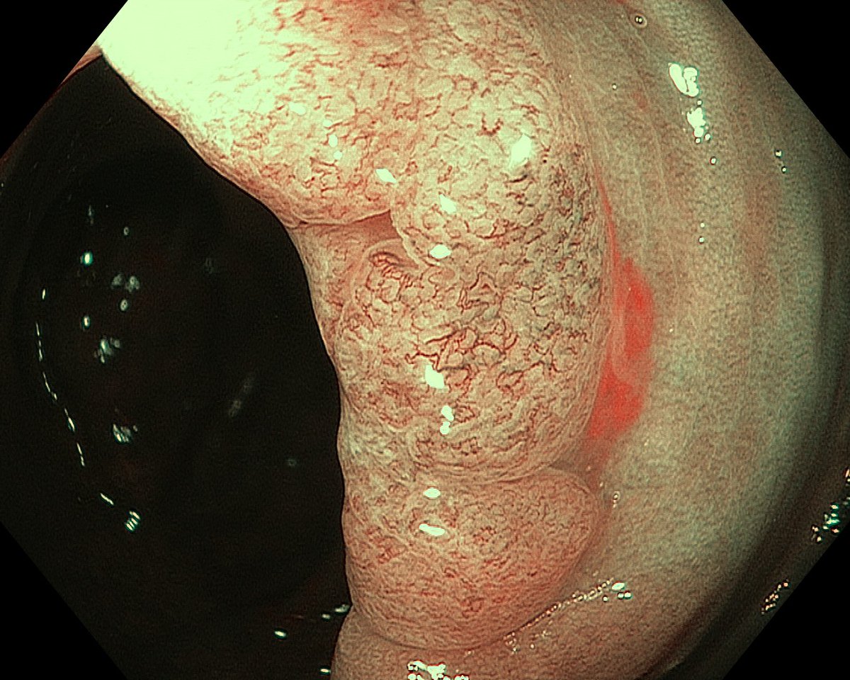 Question for the #endoscopy geeks! 🤓

🧓🏼Frail ≈ 75yo
🍄40mm LST-NG-FE in right colon. 

Would you say this is...
(2 polls in thread)

#GItwitter 
#SoMe4endoscopy