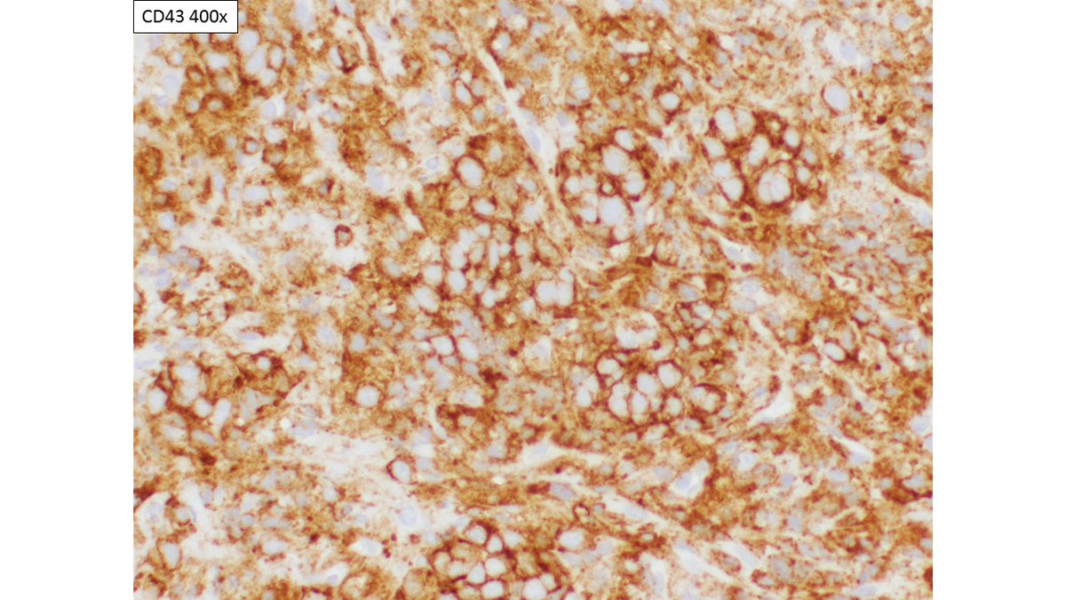 Thank you all for participating - I had the same d/d as everyone else.  @HubertLauMD mentioned the one stain that finally helped - CD43.  #PediPath  #Pathology  #PathResidents  #smallbiopsy  #HemePath  #Sarcoma