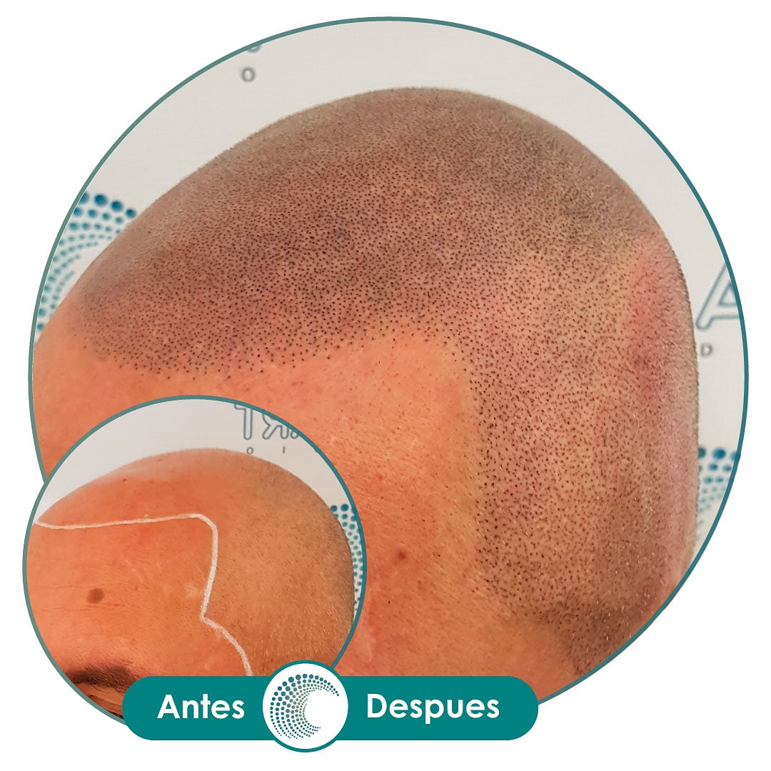 MicroCapilart's tweet photo. Paciente con efecto rapado en la que la Micropigmentación se aplicó en la zona de los laterales de la cabeza, donde también había perdido cabello,  obteniendo un resultado parejo.⁠
⁠ https://t.co/fOaom9QO0S