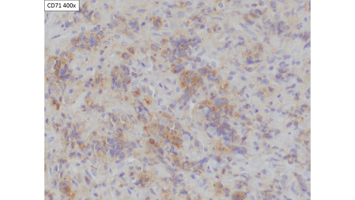 As suggested by  @HubertLauMD and  @hematogones, I followed up the positive CD43 with a few additional myeloid stains.  #PediPath  #Pathology  #PathResidents  #smallbiopsy  #HemePath  #Sarcoma