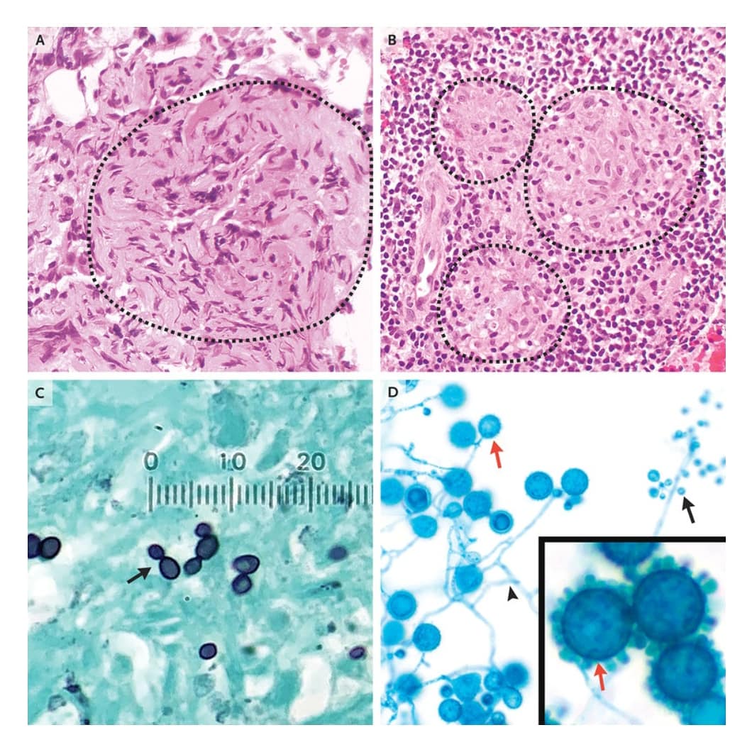 NEJMCPC's tweet photo. Dr. @katrinarmstrong, Chief of @MGHMedicine at @MassGeneralNews, expertly discusses the differential dx for this week's @NEJM #CaseRecords:⁣
Case 16-2020: 48W w/ Recurrent #Melanoma &amp; Pulm Nodules.
⁣
Congrats Drs. Armstrong, @DrJustineCohen, Shepard, Folch, Mansour, @jastefely! https://t.co/2GhUtEdZSE