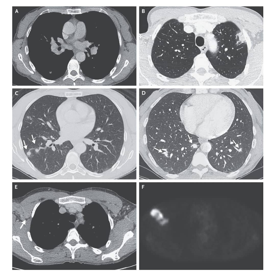 NEJMCPC's tweet photo. Dr. @katrinarmstrong, Chief of @MGHMedicine at @MassGeneralNews, expertly discusses the differential dx for this week's @NEJM #CaseRecords:⁣
Case 16-2020: 48W w/ Recurrent #Melanoma &amp; Pulm Nodules.
⁣
Congrats Drs. Armstrong, @DrJustineCohen, Shepard, Folch, Mansour, @jastefely! https://t.co/2GhUtEdZSE