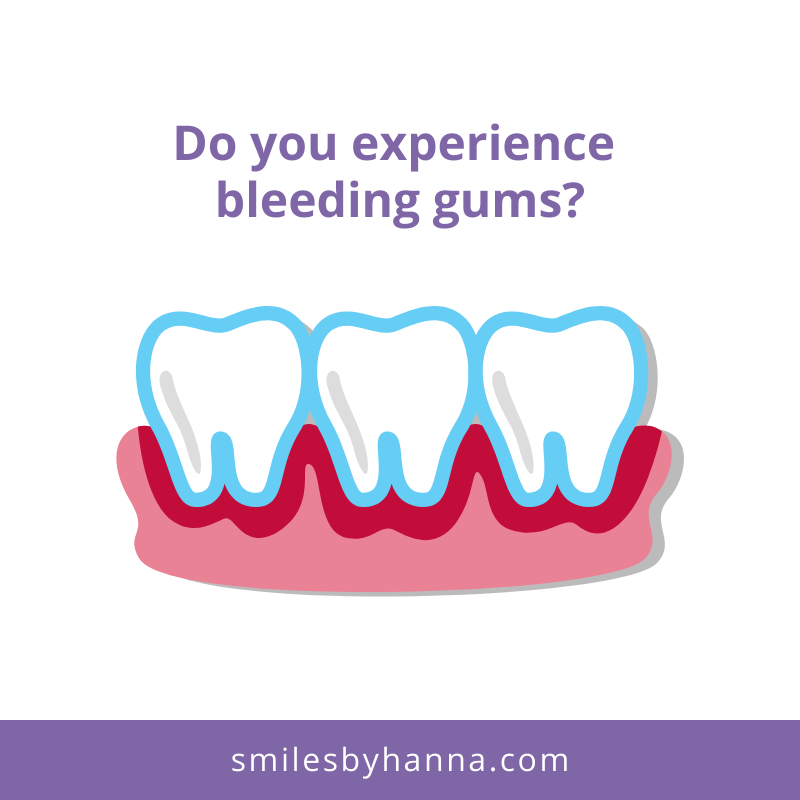 Dentist_Gilbert's tweet photo. How to prevent bleeding gums?

• Brush your teeth at least 2x a day
• Floss at least 1x a day
• Rinse daily w/ an antibacterial mouthwash
• See your dentist regularly

Do you experience excessive gum bleeding? Contact us at (602) 413-0580 to set up a virtual consultation. https://t.co/pMNfUzcZFk