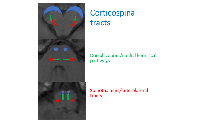 Let’s knock out 1 and 2The corticospinal tracts (motor) are the most VENTRAL/ANTERIOR structure (blue)The ascending sensory pathways (dorsal columns (green) and spinothalamic tracts (red)) are DORSOLATERAL (except for the medial lemnisci briefly being medial in the medulla)