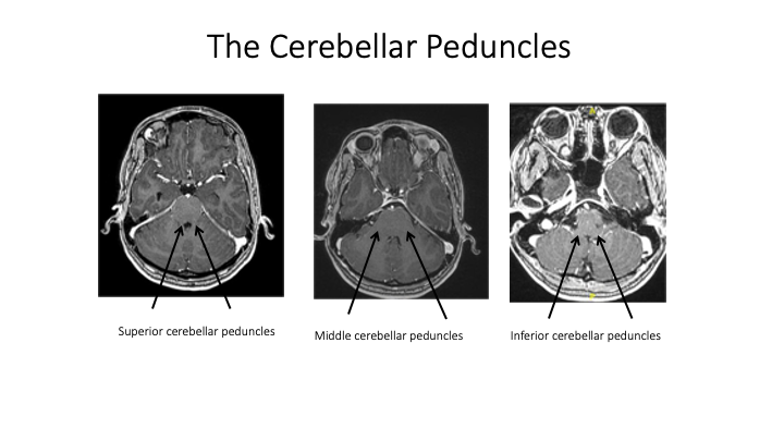 Cerebellar peduncles run posteriorly, makes sense because the cerebellum is posterior to the brainstem. We’ll discuss these in another tweetorial. For now, just remember those big cables connecting pons to the cerebellum are the middle cerebellar peduncles.