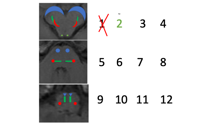 2: optic-we'll cover the visual pathways in another tweetorial, but they don't go to the brainstem...but the afferent limb of the pupillary reflex does, and goes to midbrain so far so good