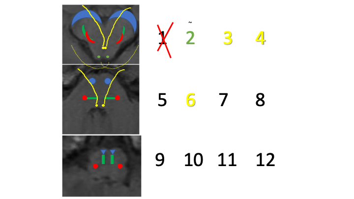 3,4,6= eye movements = MOTOR. We'll discuss in detail in another tweetorial.3,4 = midbrain6 = ponsas expected from 1-4/5-8/9-12ALL RIGHT AT MIDLINE = MOTOR