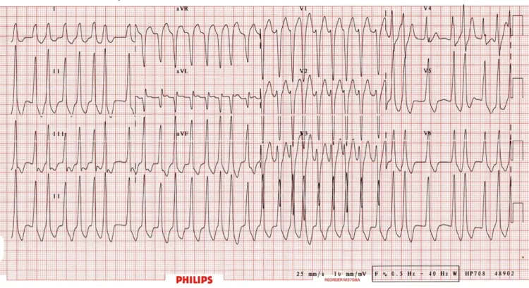  #Medstudenttwitter: Here's a case for you. 42 yo M presents with palpitations, BP is 125/84, HR is 250 on the monitor. Anxious but otherwise stable. The next post has his old ECG for comparison followed by a poll for what you should do next?